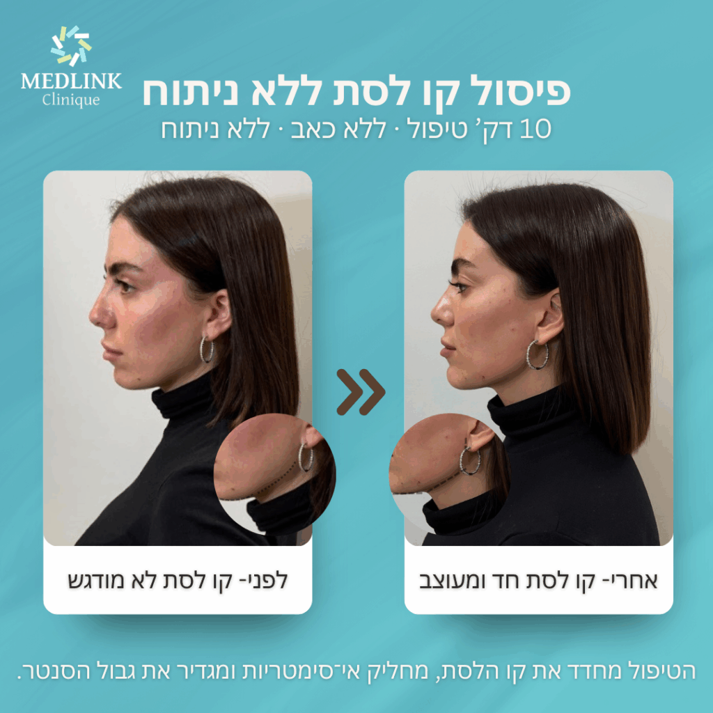 עיצוב קו לסת