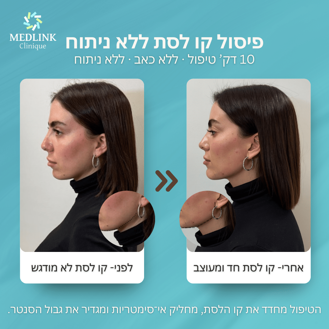 עיצוב קו לסת