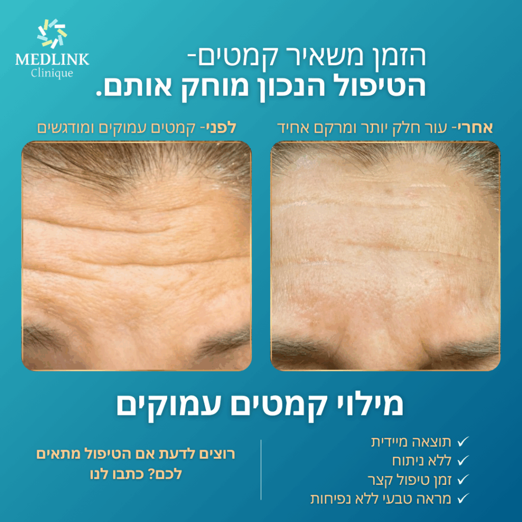 הזרקות לפנים