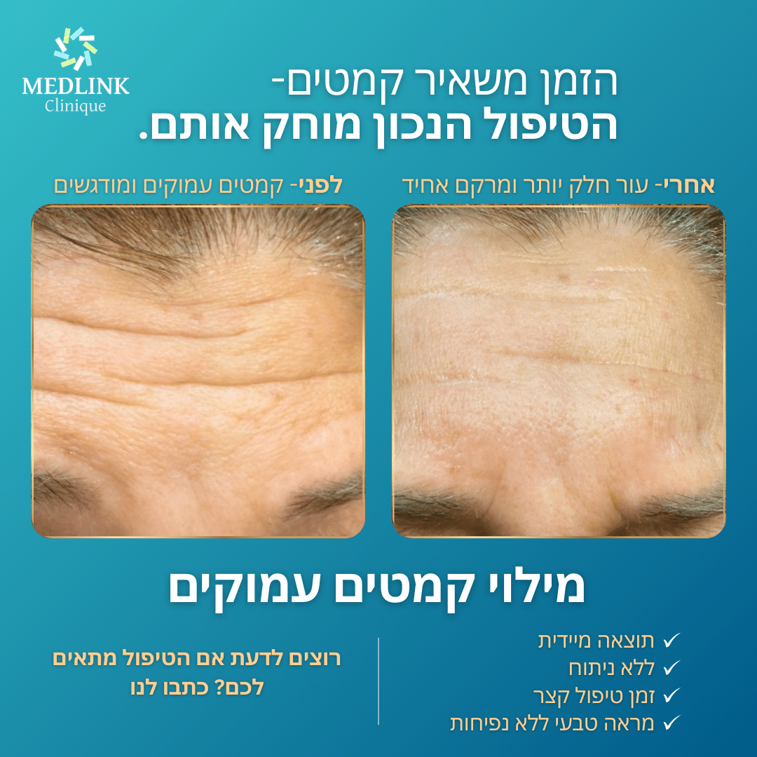 הזרקות לפנים