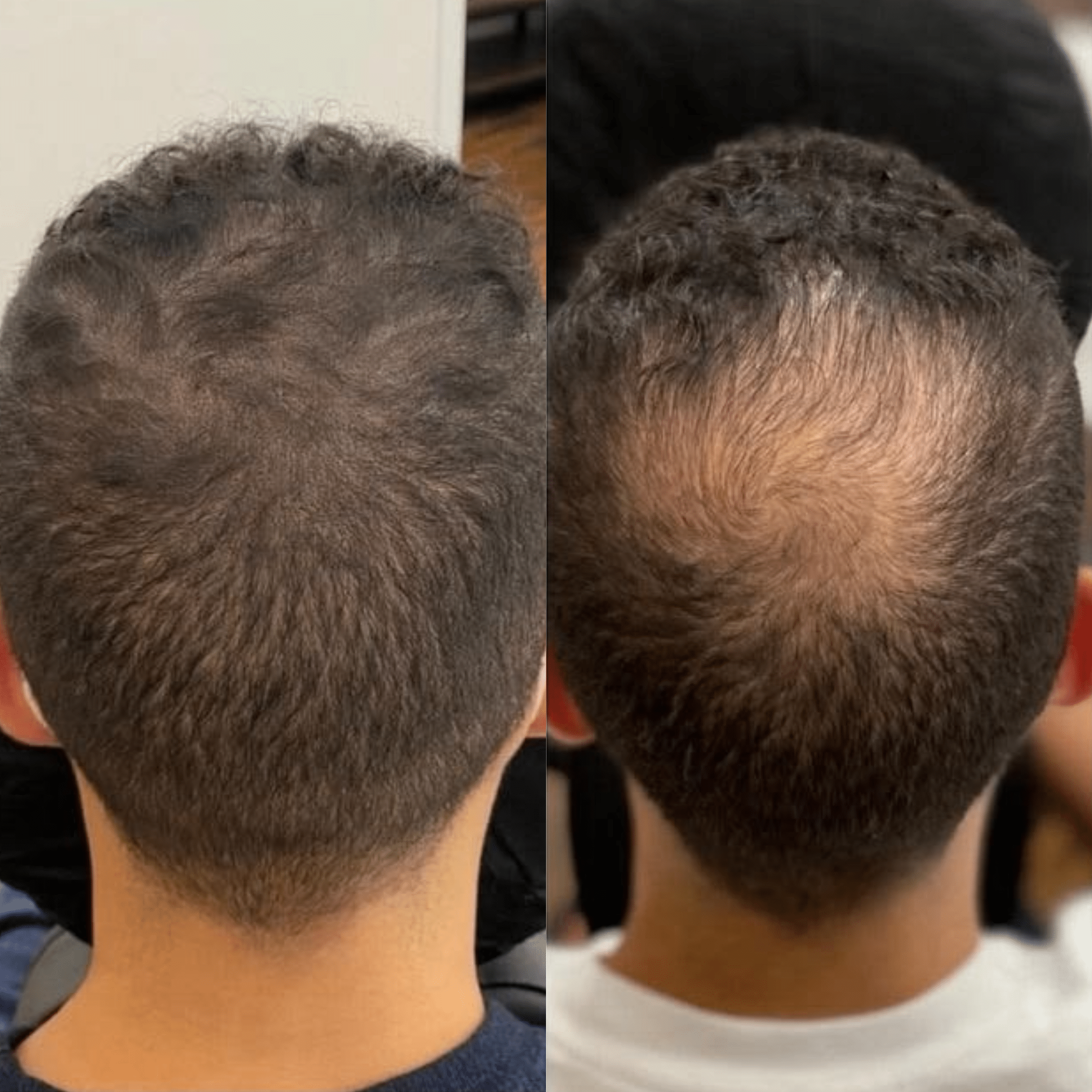עבודה 2 – טיפול IPRF לשיער