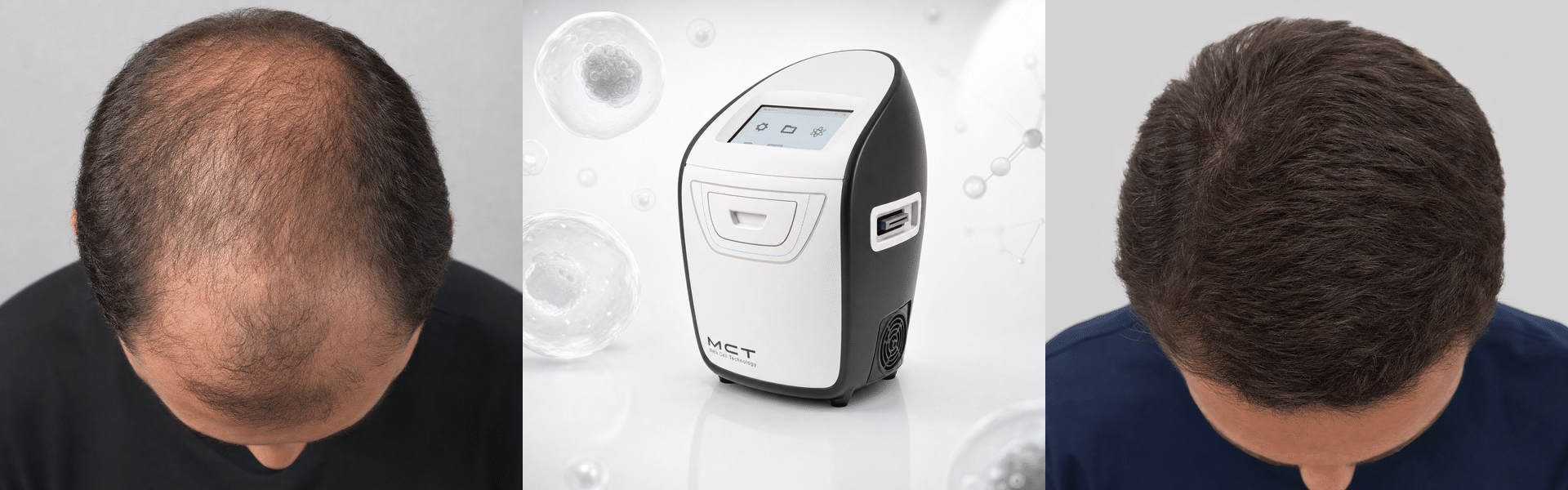חידוש שיער עם טכנולוגיית MCT - Medlink Clinique