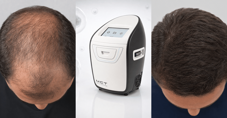 חידוש שיער עם טכנולוגיית MCT - Medlink Clinique
